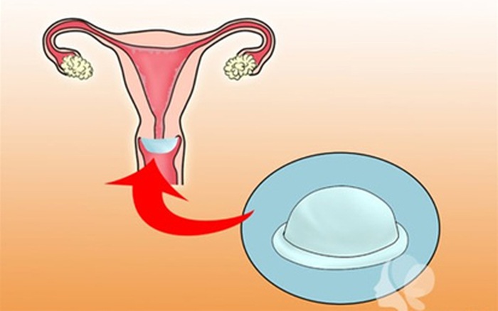 cách quan hệ tránh có thai bằng cách Sử dụng màng chắn âm đạo